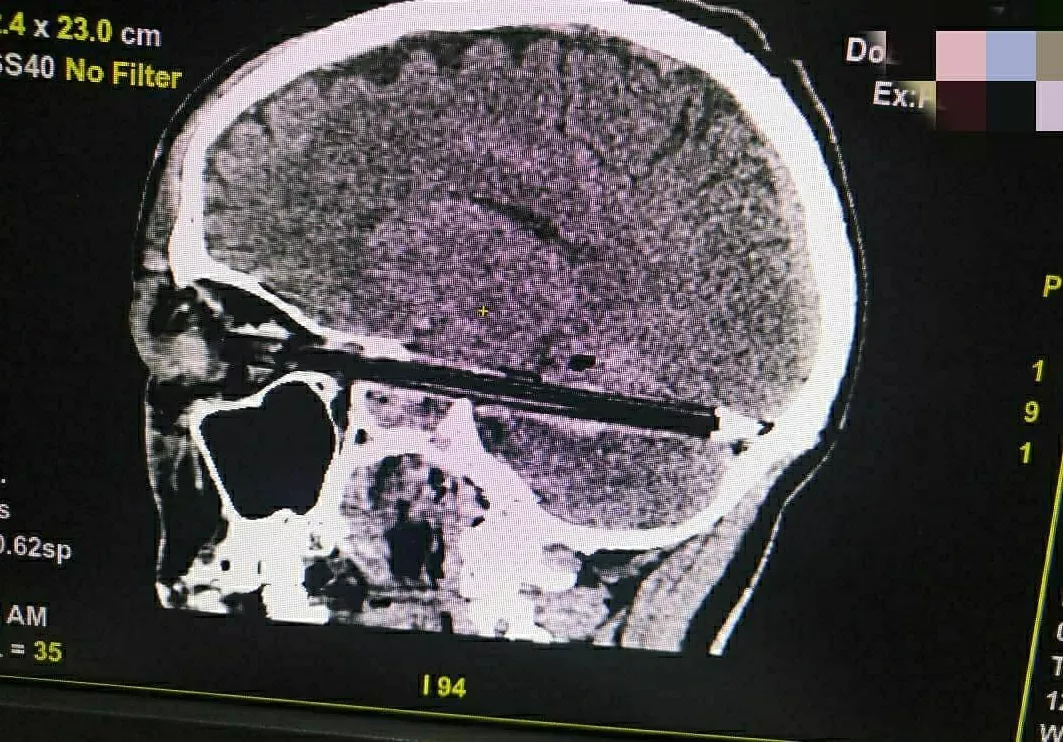Hình chụp bệnh nhân bị cây bút bi đâm vào sọ.